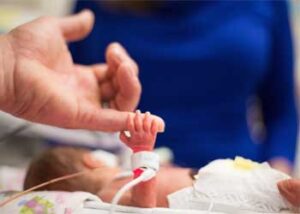 نوزاد نارس در NICU