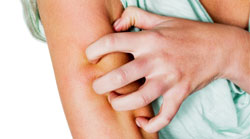 آبله مرغان در بارداری