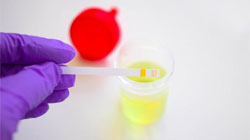 آزمایش دفع پروتئین در بارداری