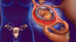 بارداری اکتوپیک