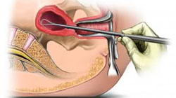 بیوپسی یا نمونه برداری از آندومتر رحم