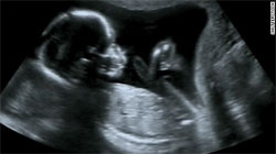تشخیص اشتباه جنسیت جنین در بارداری
