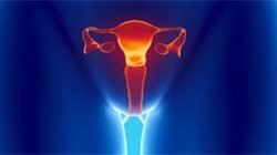 تنگی-دهانه-رحم-و-ناباروری تنگی دهانه رحم و ناباروری