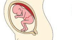 جفت خلفی در بارداری ئ عوارض آن