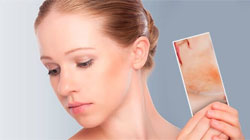 جوش پوستی در بارداری