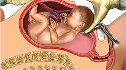 زایمان-سزارین زایمان سزارین