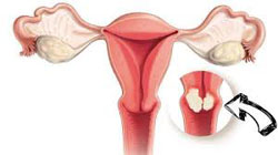 سرویسیت یا التهاب دهانه رحم