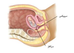 سرکلاژ در بارداری
