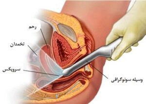 سونوگرافی واژینال