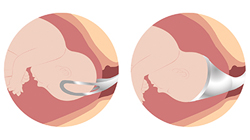 فورسپس و وکیوم در زایمان