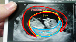 هماتوم پشت جفت