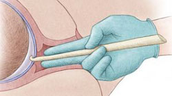 پاره شدن عمدی کیسه آب