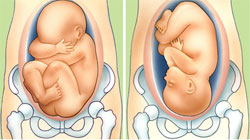 چرخش جنین بریچ در شکم مادر