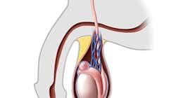 کیست بیضه یا اپیدیدیم